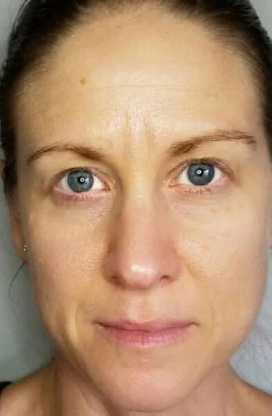 Simpla 360 helped rejuvenate the skin and lighten the stains