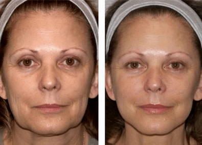 before and after
